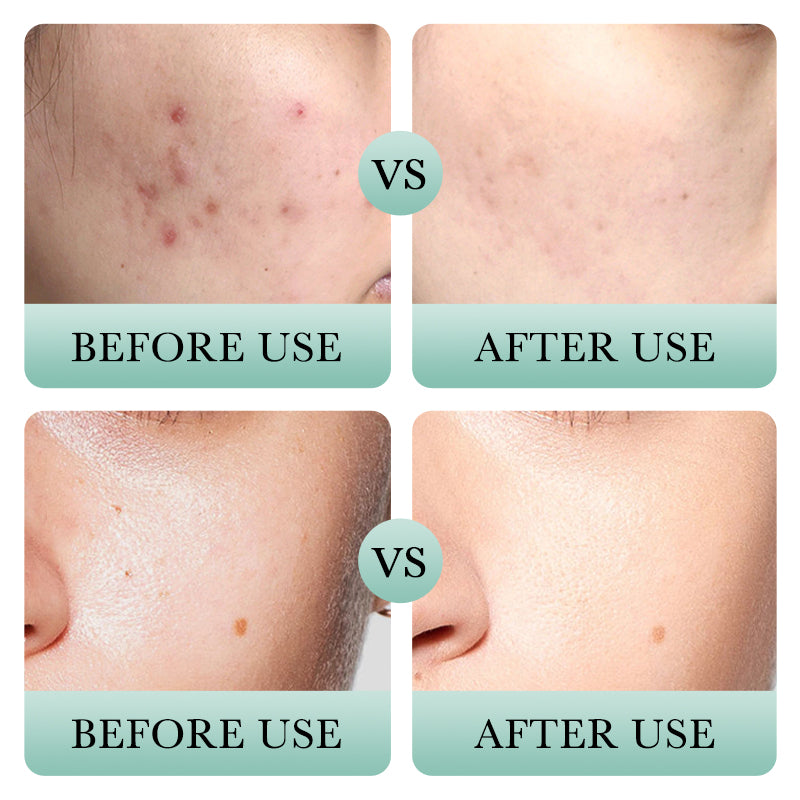 BIOAQUA - Salicylic Acid Acne Removal Cleanser 100g